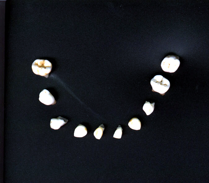 fh-childhood-teeth